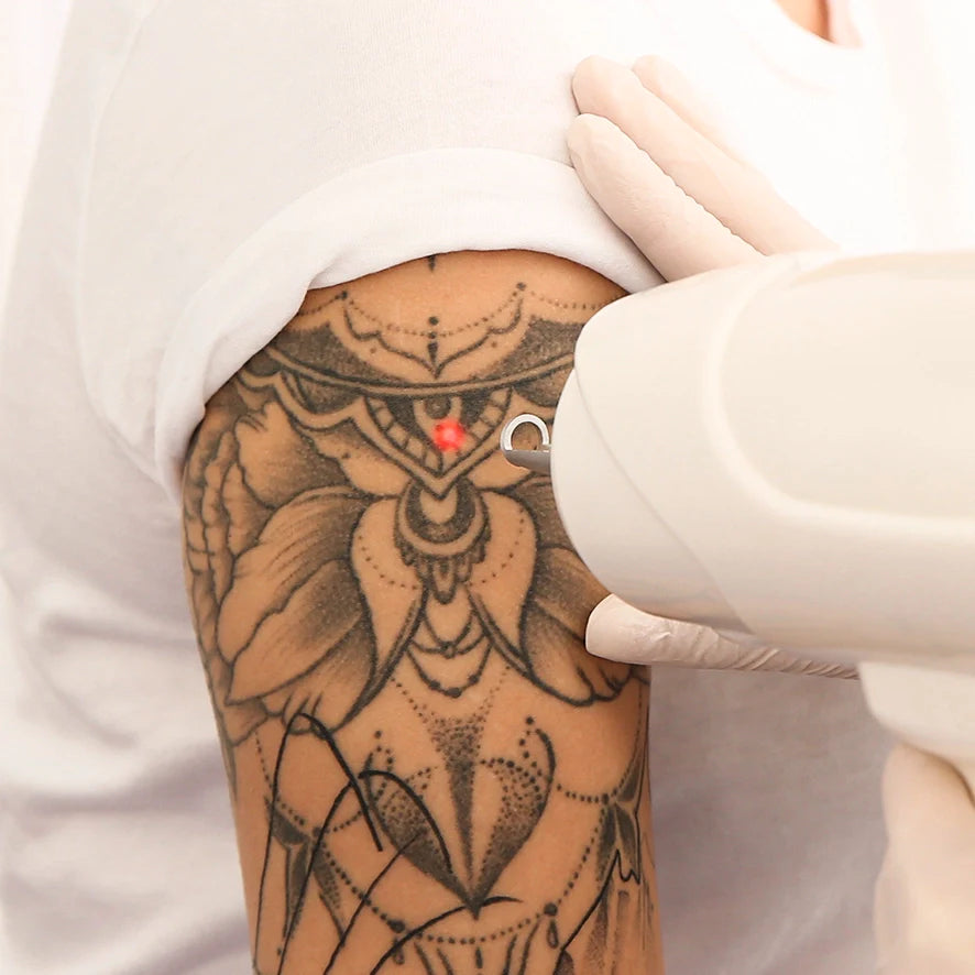 Can ND Yag Laser Completely Remove Colour Tattoos? Deluxe Shop's Expertise in South Africa