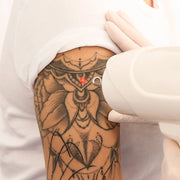ND - Yag Laser - Tattoo Removal Large